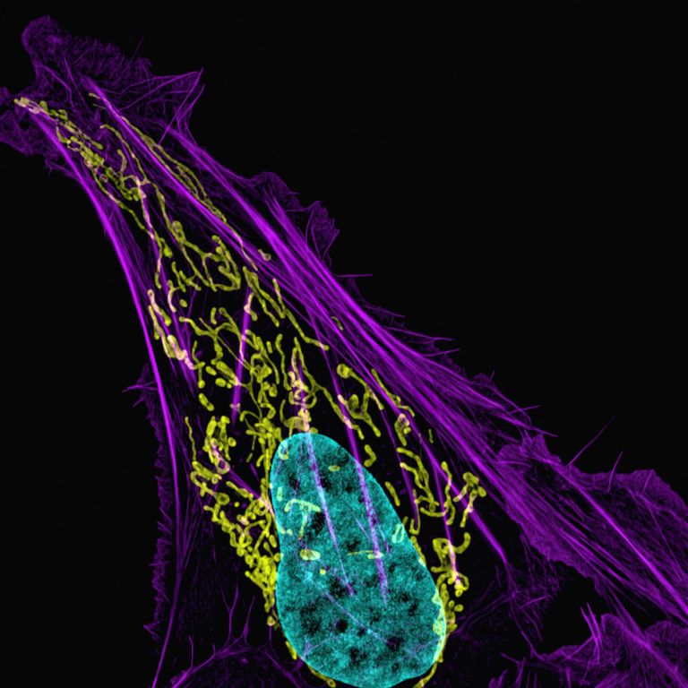 Microscopic image of Osteosarcoma.